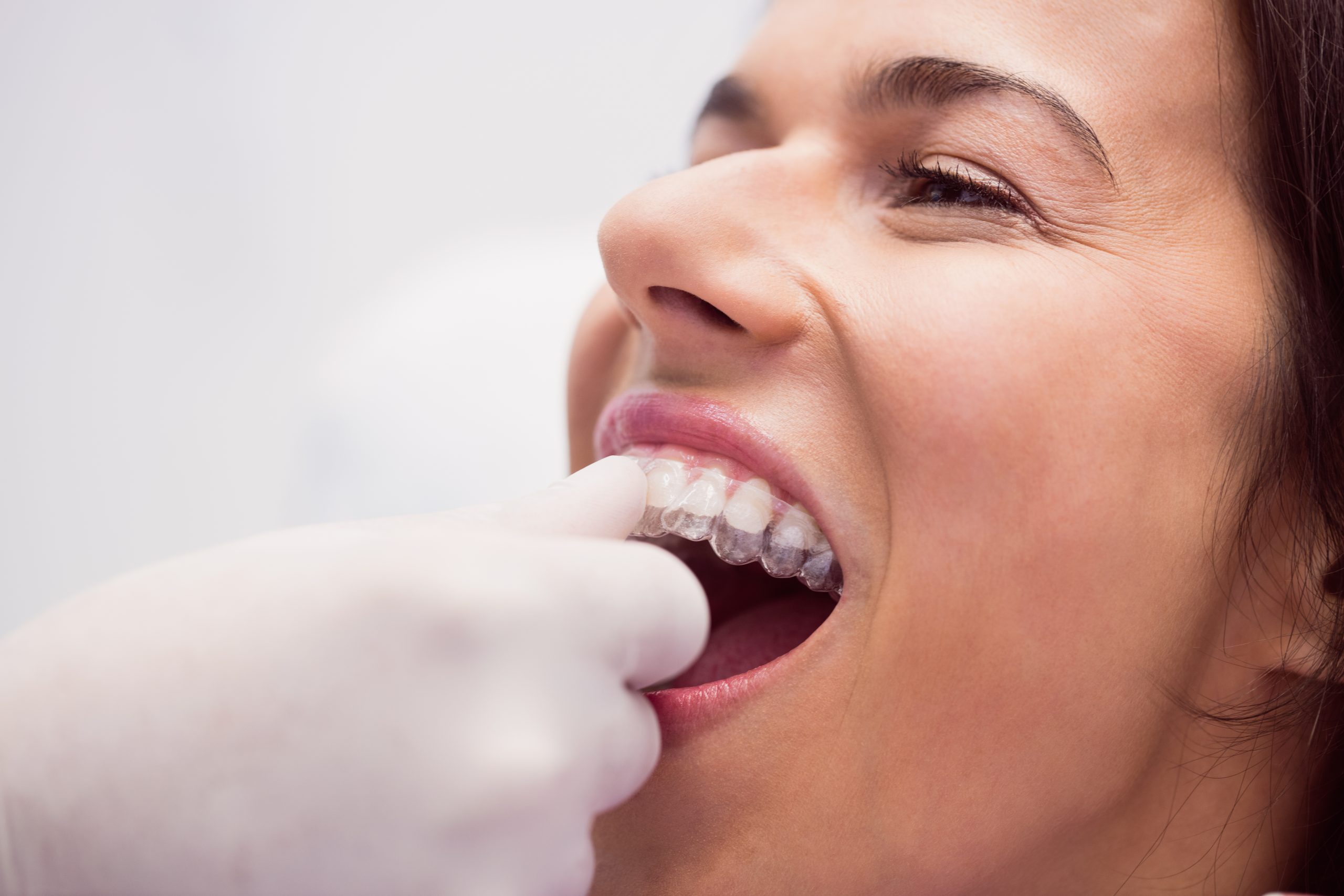 Unveiling Your Perfect Smile: A Guide to Invisalign Treatment at Delicate Dentistry in Marion, SA