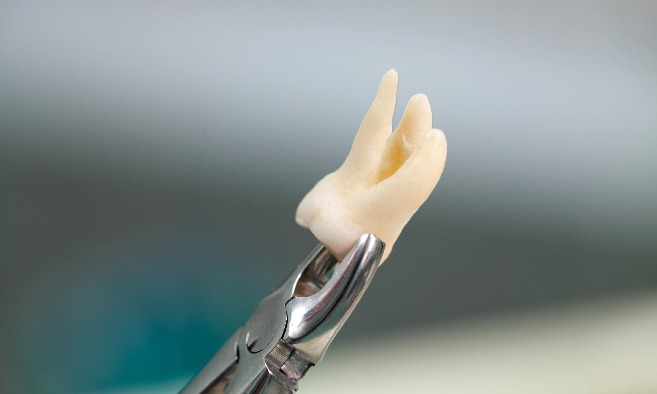 When is the Best Time for Wisdom Teeth Removal?