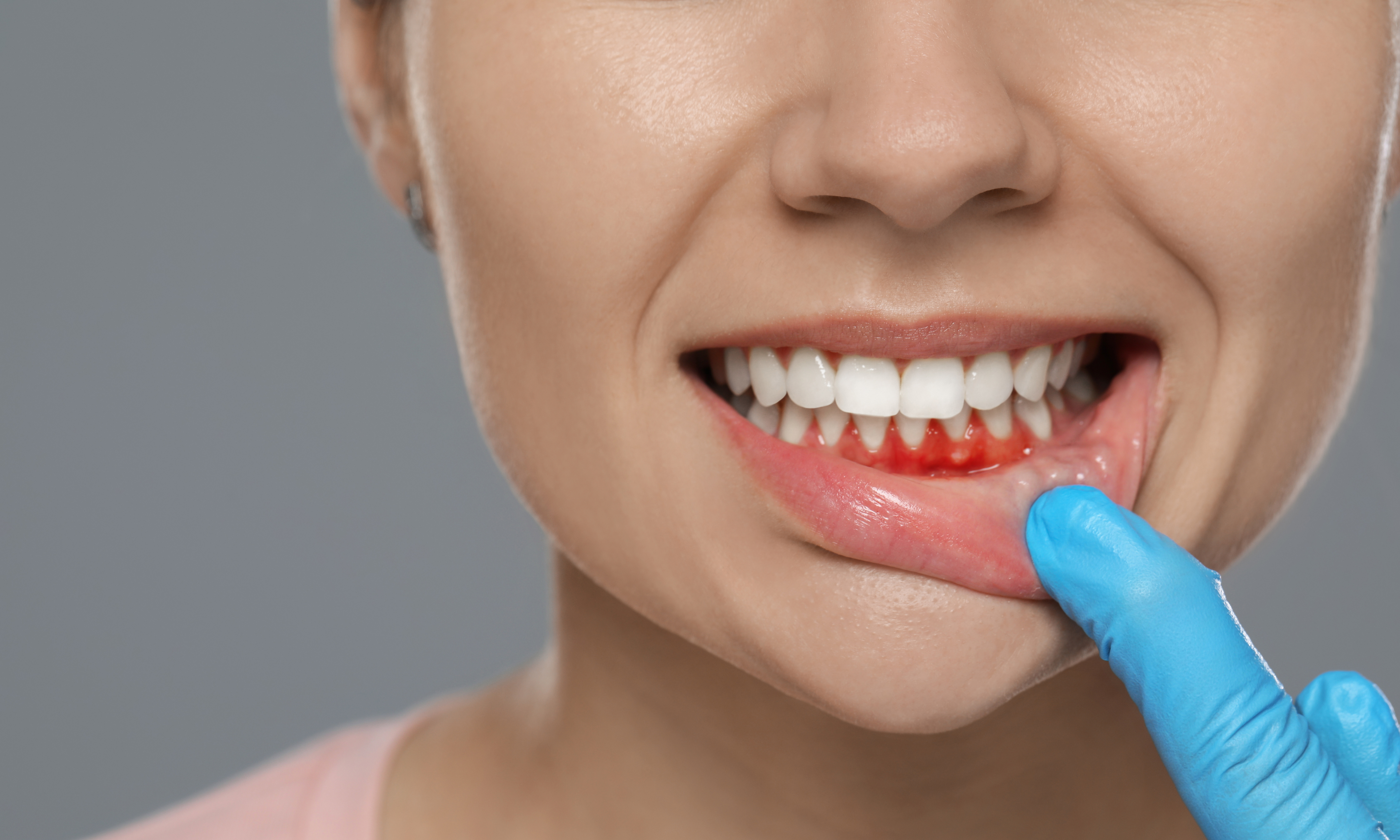 Gum disease treatment and prevention