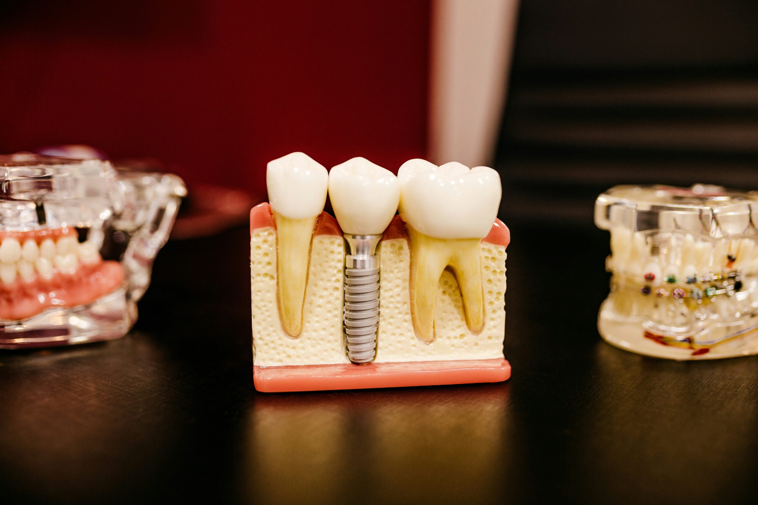 Dental implants: What you need to know
