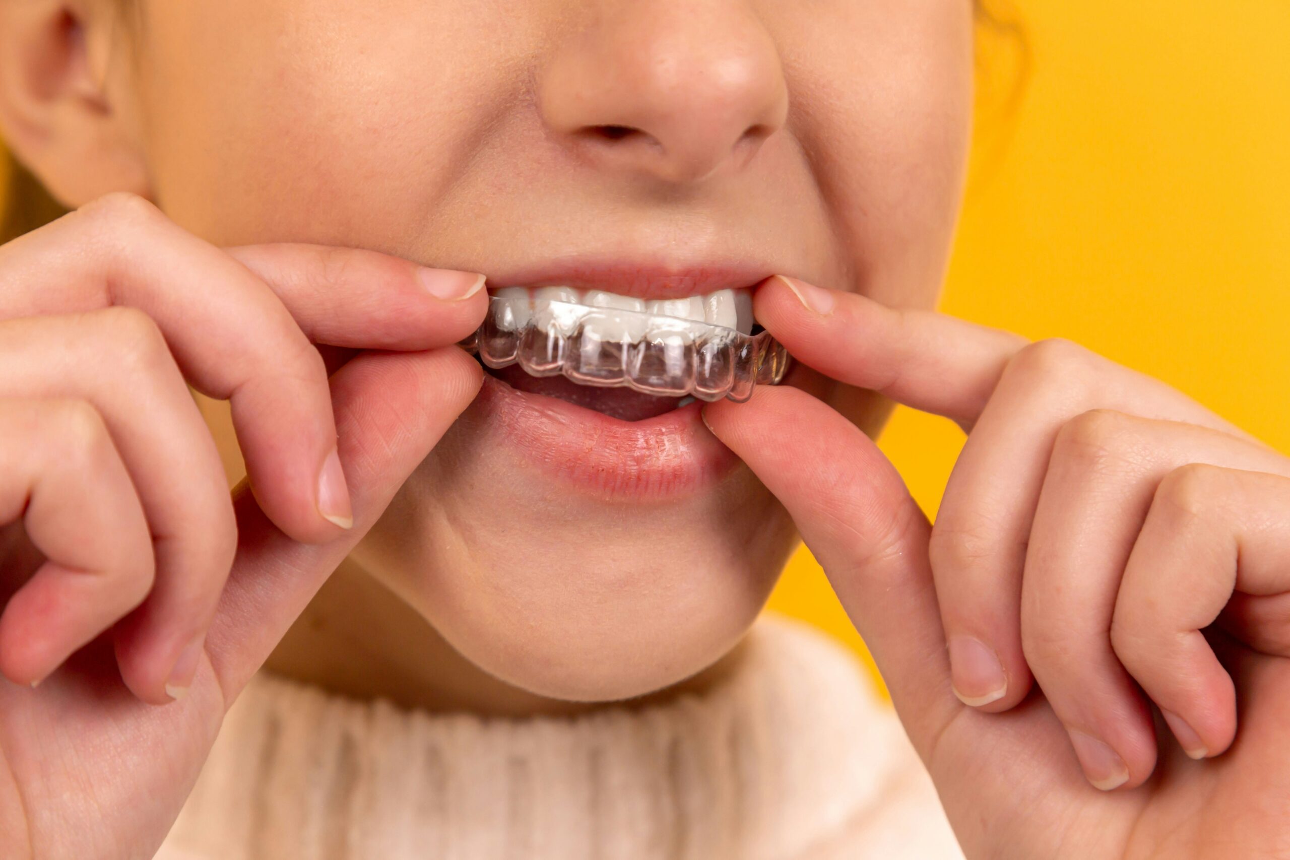Eating and Drinking with Clear Aligners