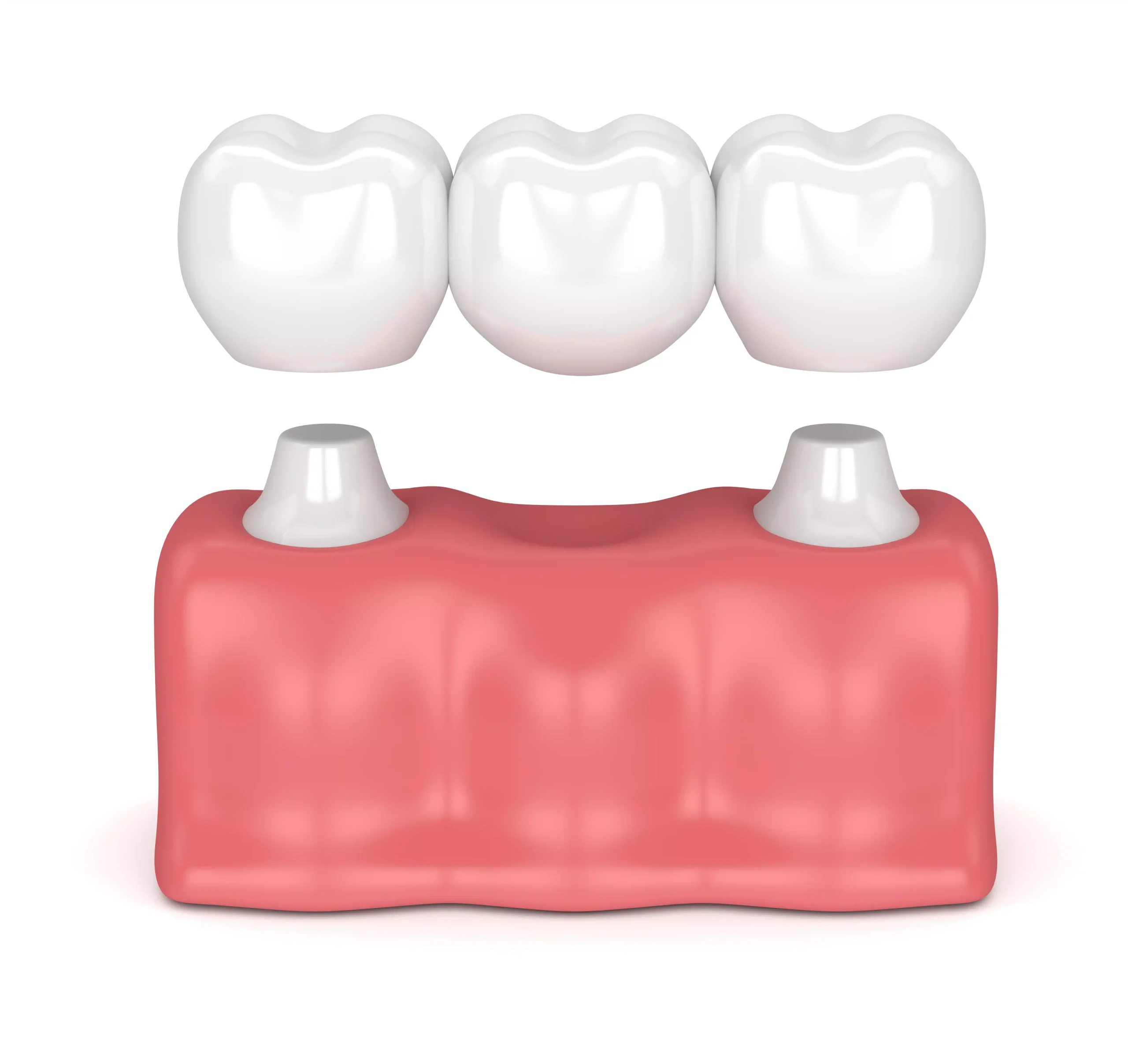 Dental Implants vs. Bridges: What’s Best for Long-Term Tooth Replacement?