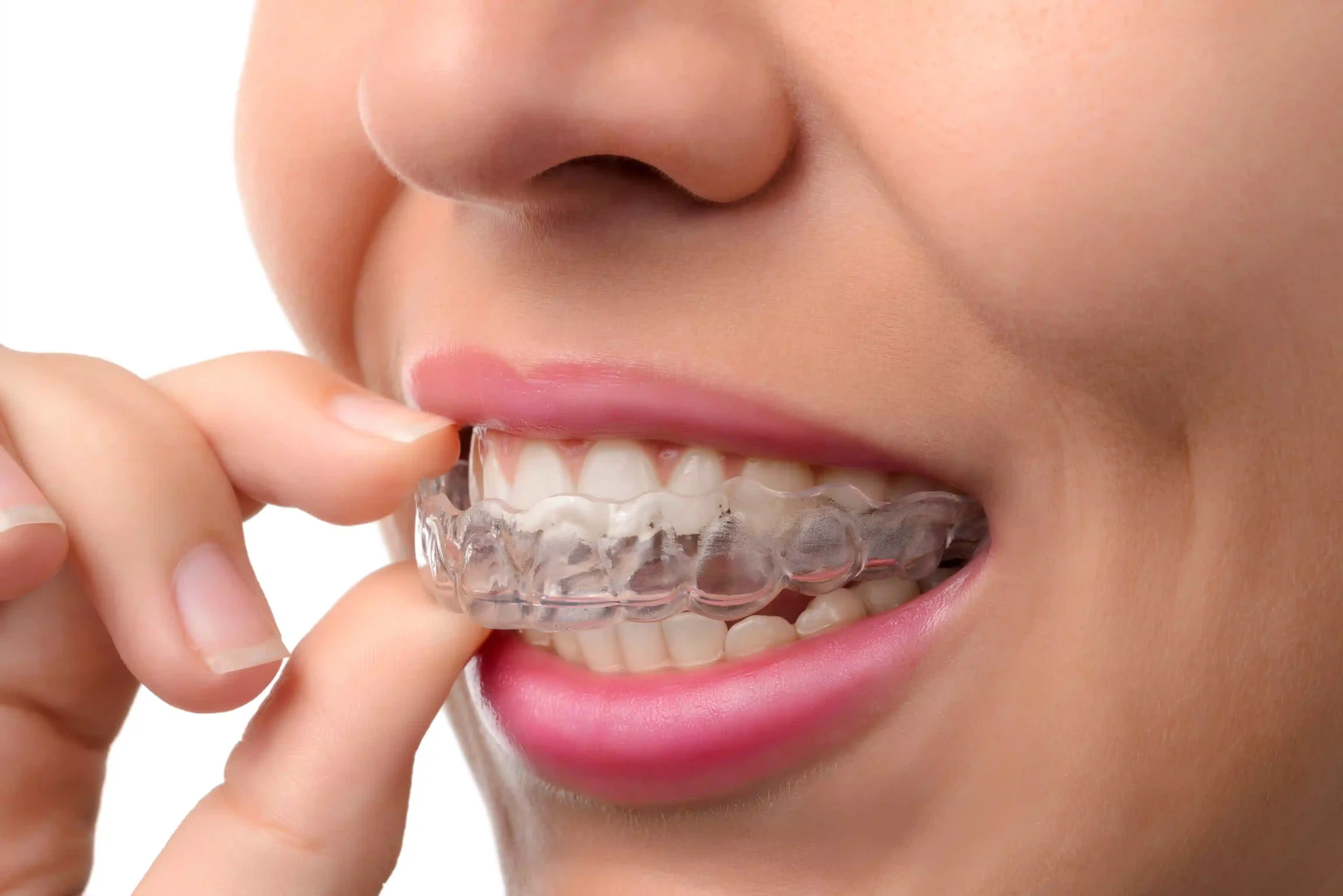 Clear Aligners in Marion: A Modern Approach to Straightening Your Smile