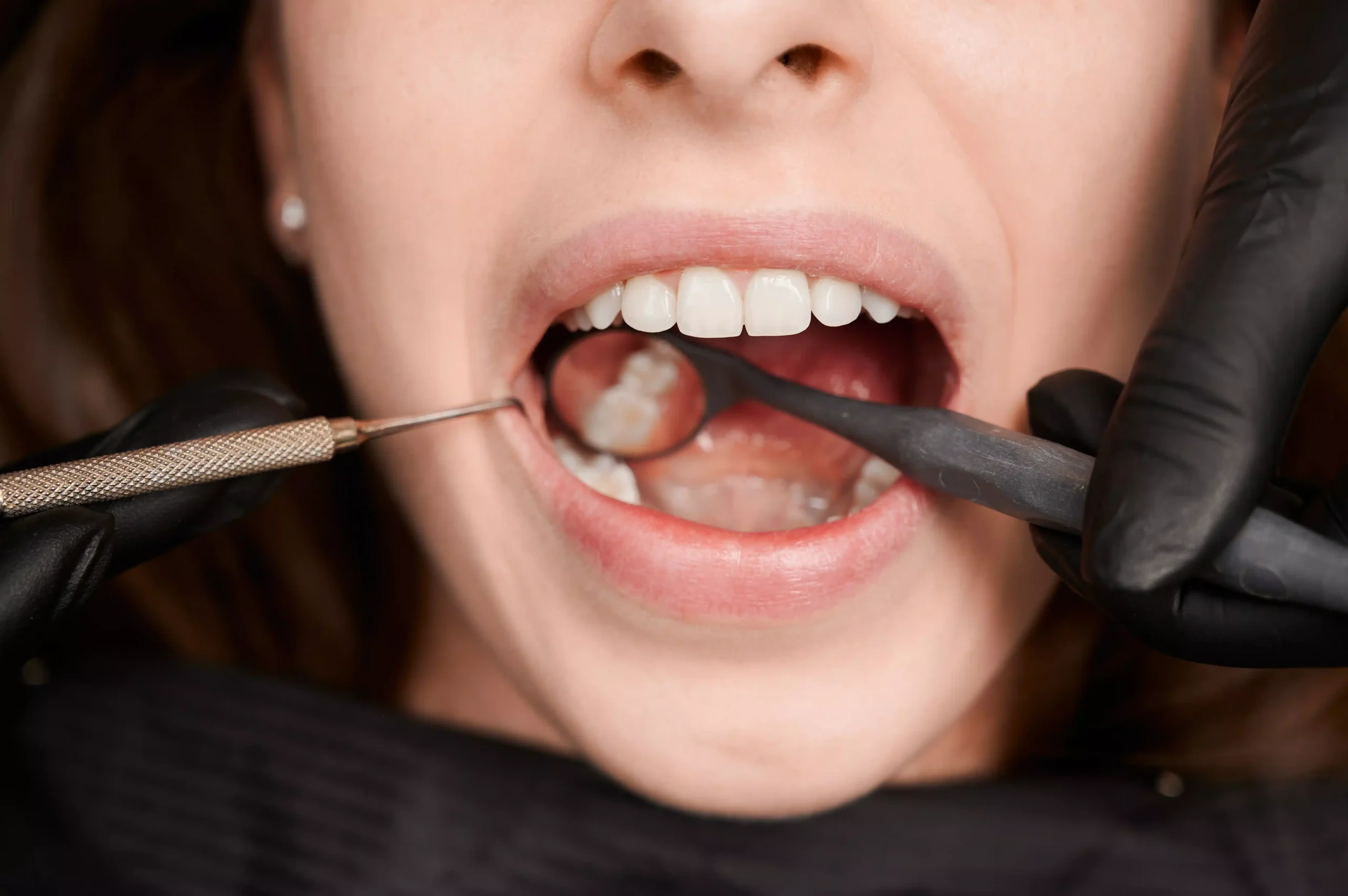 5 Signs You May Need a Dental Filling in Marion