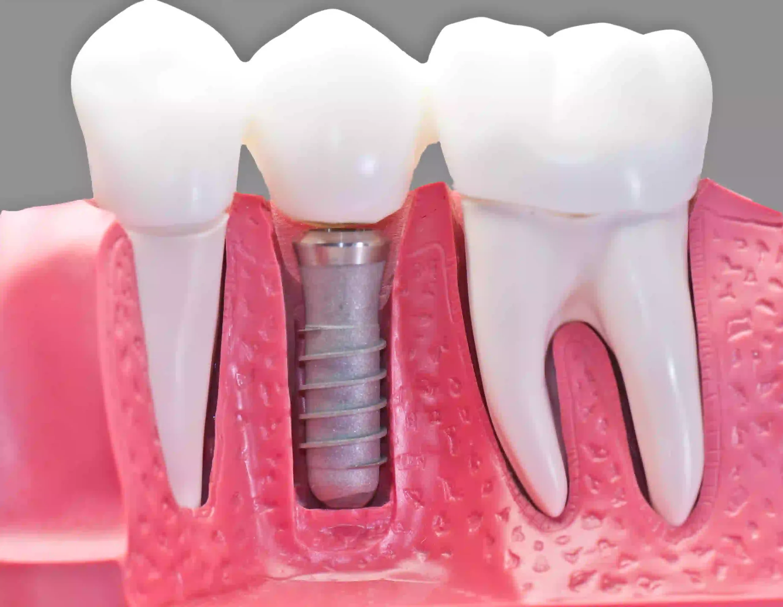 Dental Implants – Restoring Missing Teeth