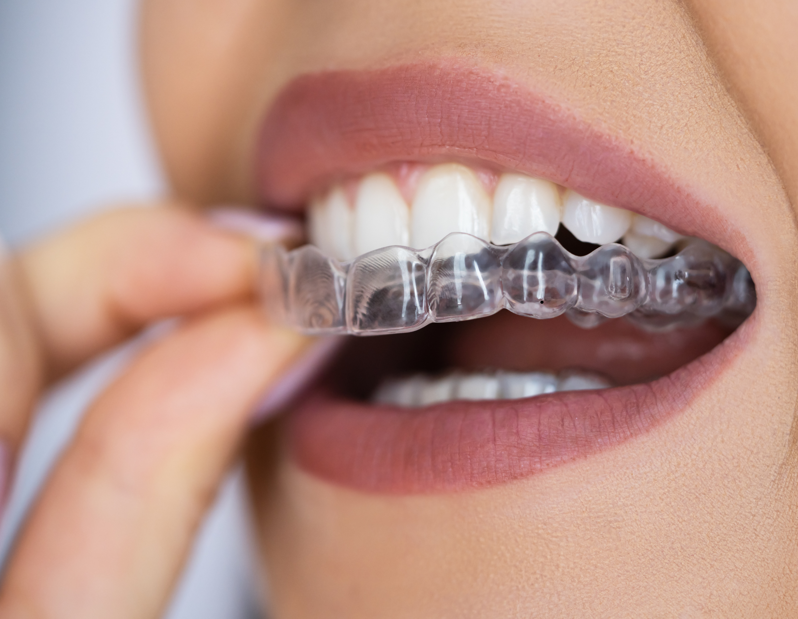 Clear Aligners in Marion SA: A Modern Way to Straighten Your Smile
