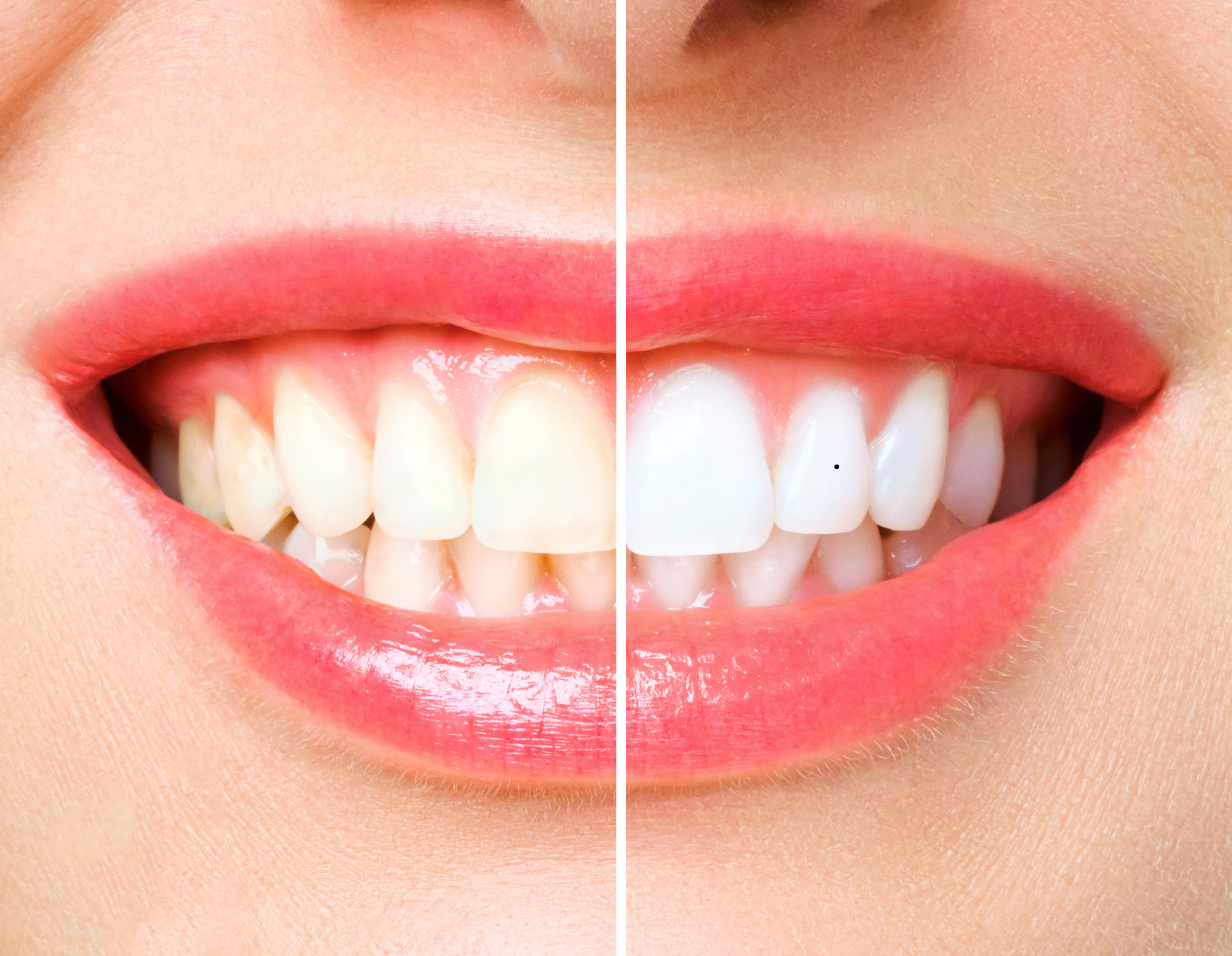 Professional Teeth Whitening in Marion SA: Is It the Right Choice for You?