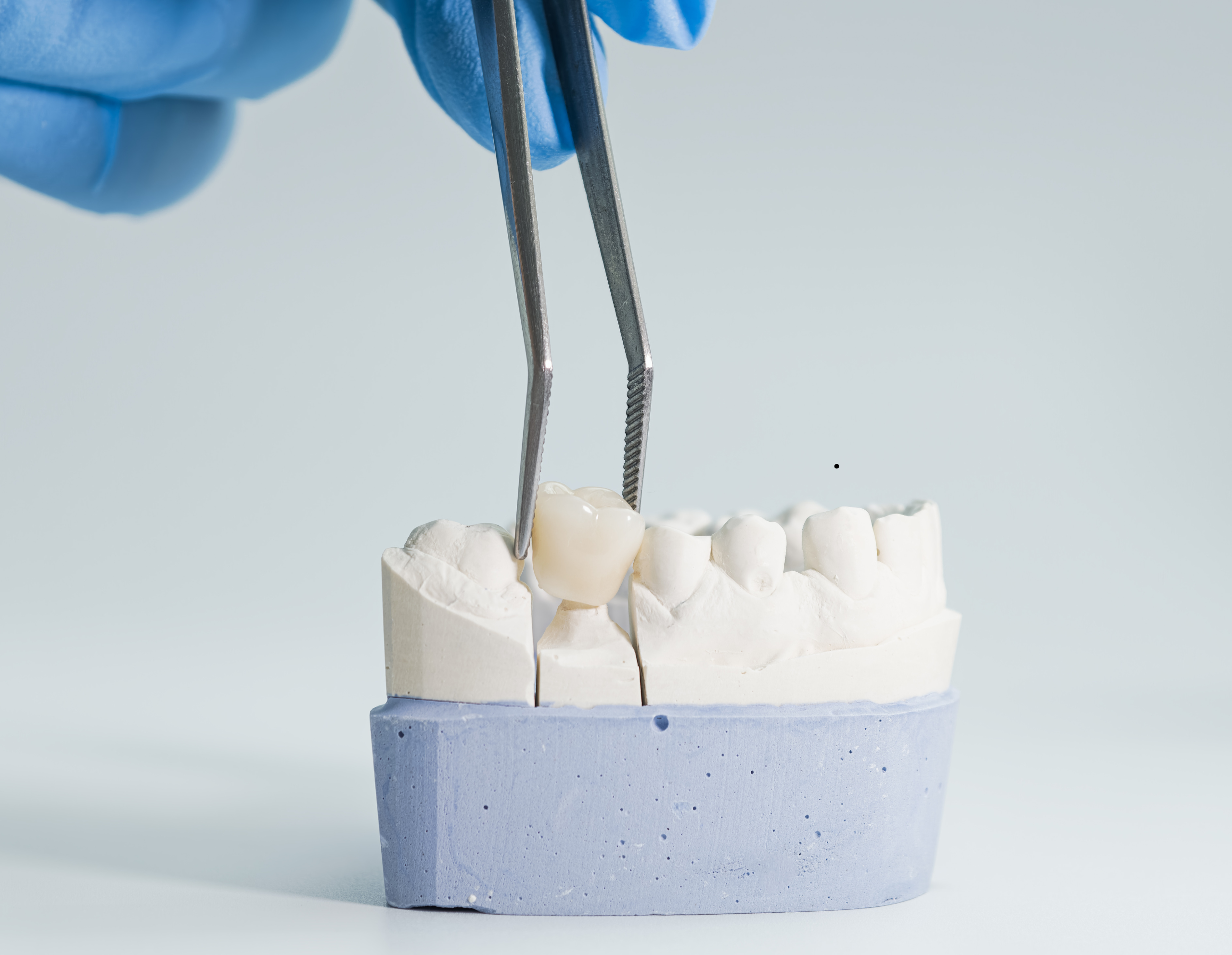 Dental Crowns in Marion SA: When Do You Need One and What Can They Fix?
