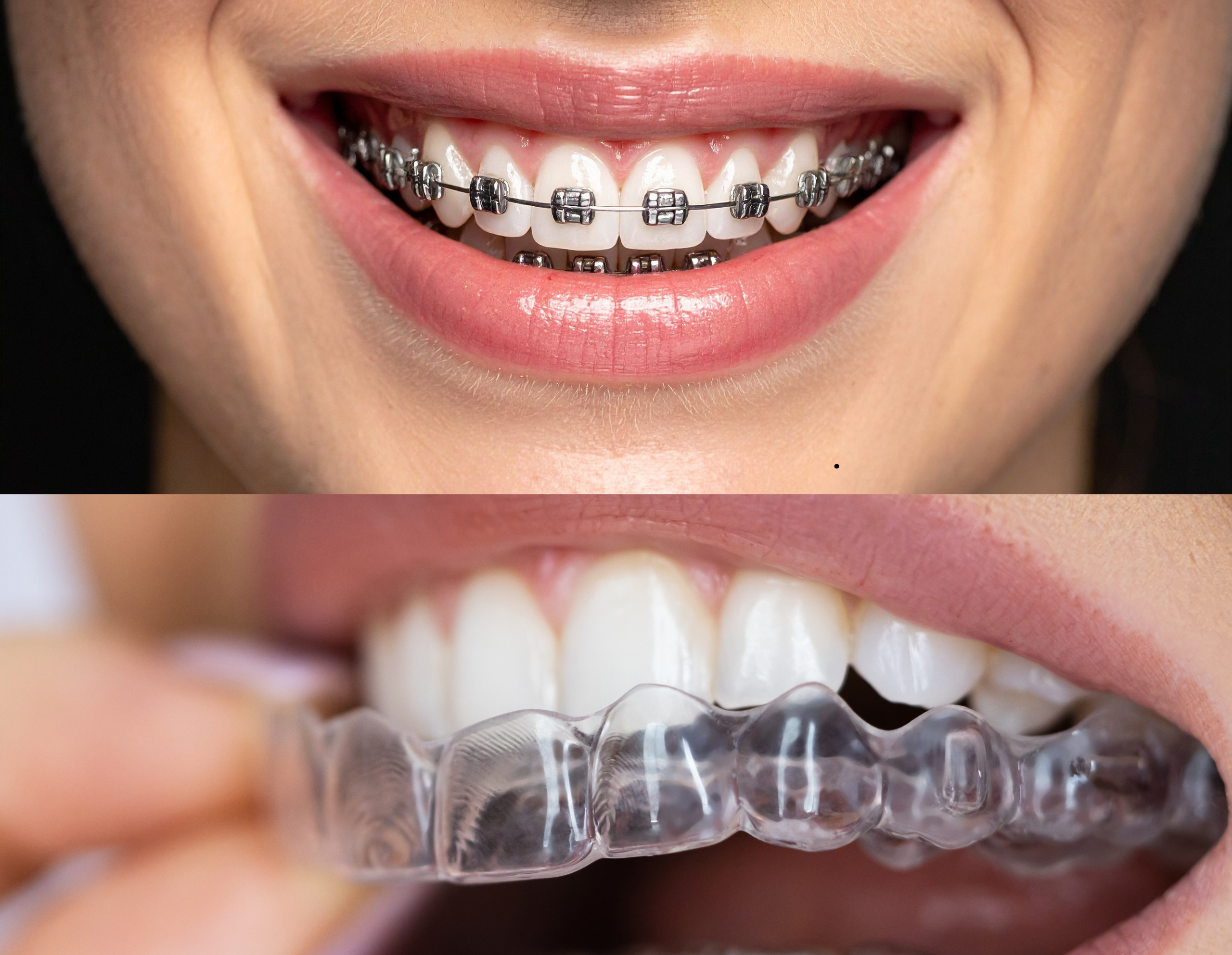 Braces vs Clear Aligners: Which Teeth Straightening Option Is Right for You?